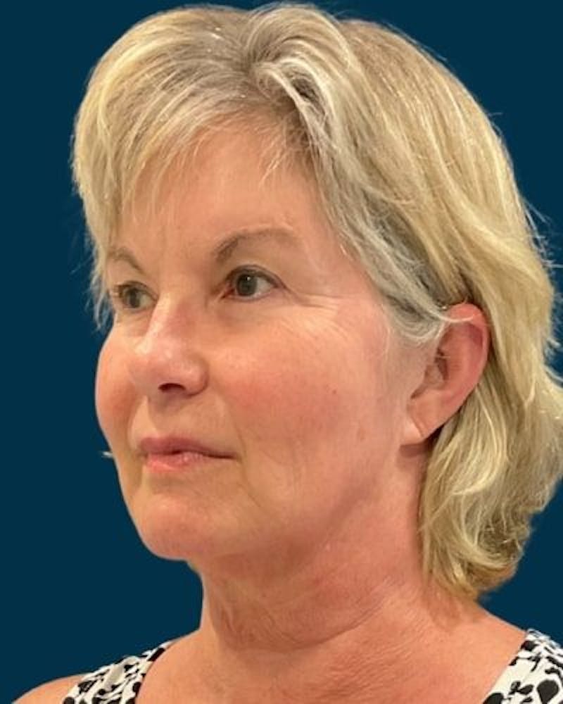 Facelift and Neck Lift Before & After Gallery - Patient 154719 - Image 7