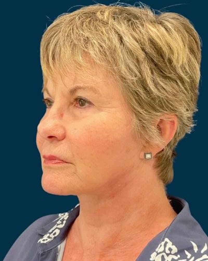 Facelift and Neck Lift Before & After Gallery - Patient 154719 - Image 8
