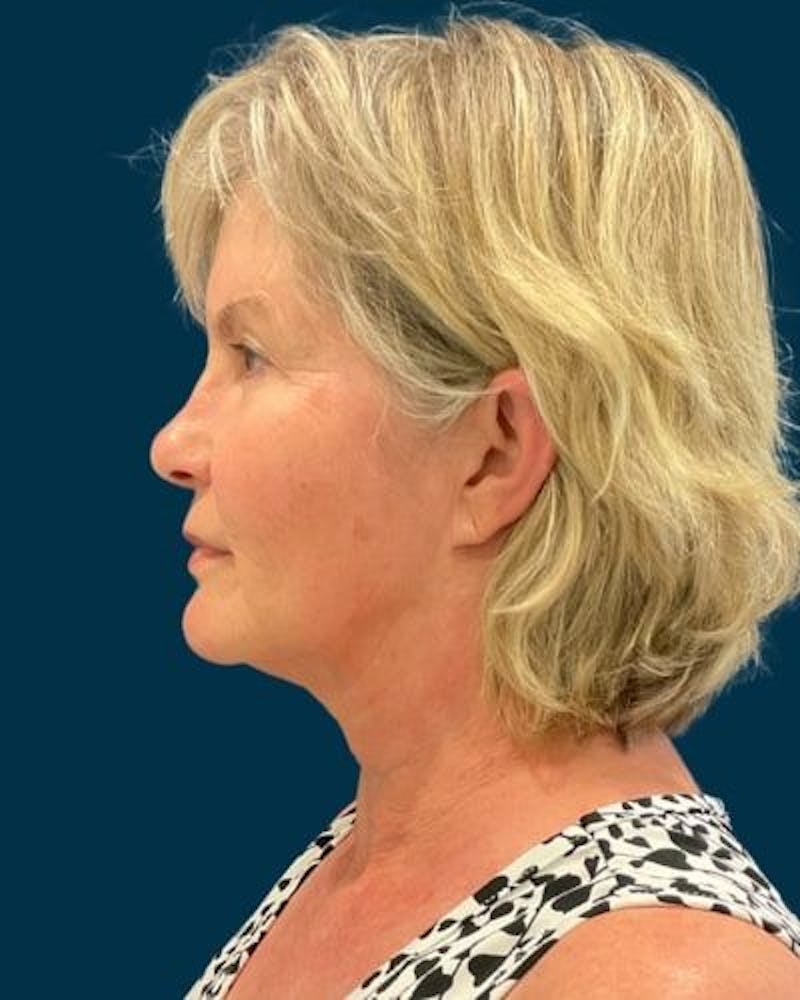 Facelift and Neck Lift Before & After Gallery - Patient 154719 - Image 9