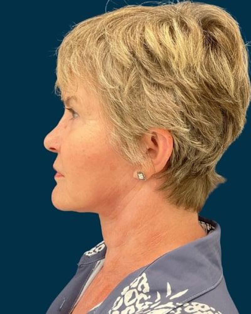Facelift and Neck Lift Before & After Gallery - Patient 154719 - Image 10