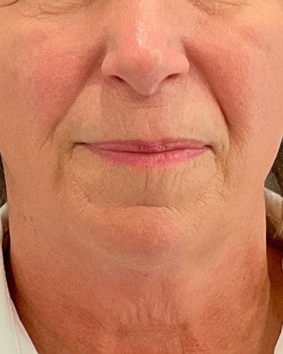 Facelift and Neck Lift Before & After Gallery - Patient 221823 - Image 1