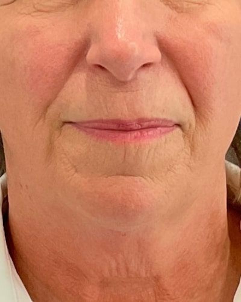 Facelift and Neck Lift Before & After Gallery - Patient 221823 - Image 1