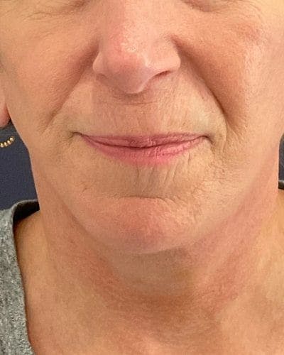 Facelift and Neck Lift Before & After Gallery - Patient 221823 - Image 2
