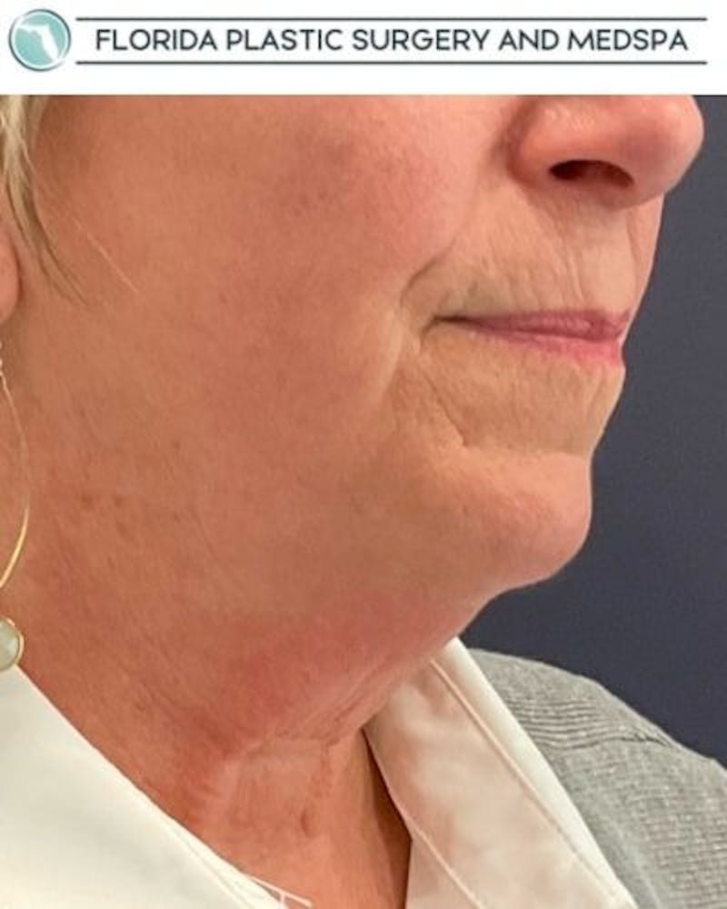 Facelift and Neck Lift Before & After Gallery - Patient 221823 - Image 3