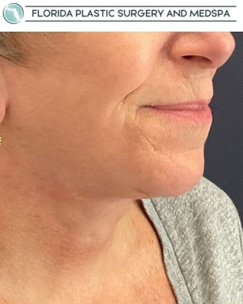 Facelift and Neck Lift Before & After Gallery - Patient 221823 - Image 4