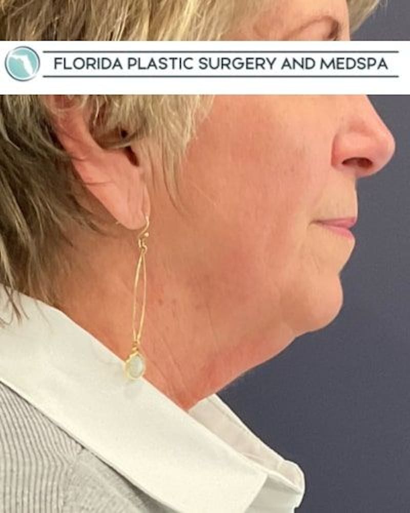 Facelift and Neck Lift Before & After Gallery - Patient 221823 - Image 5