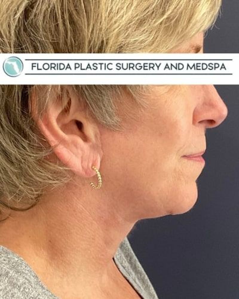 Facelift and Neck Lift Before & After Gallery - Patient 221823 - Image 6