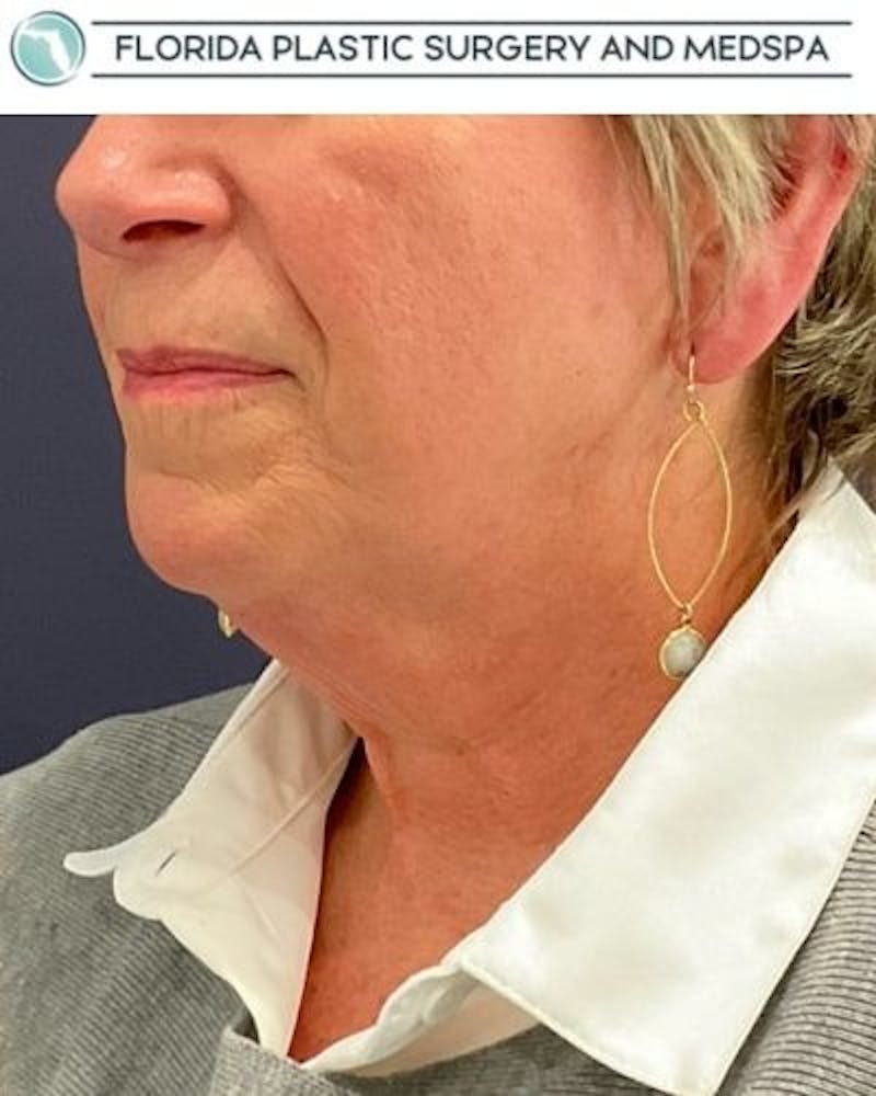 Facelift and Neck Lift Before & After Gallery - Patient 221823 - Image 7