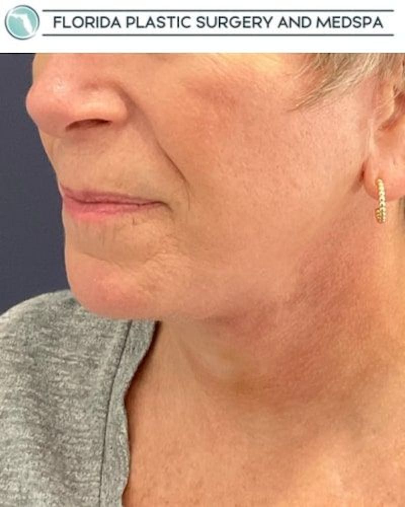 Facelift and Neck Lift Before & After Gallery - Patient 221823 - Image 8