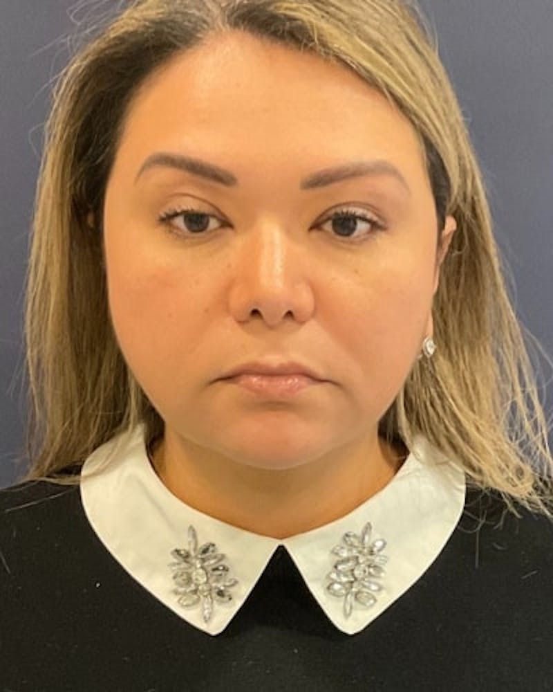 Facelift and Neck Lift Before & After Gallery - Patient 142028 - Image 2