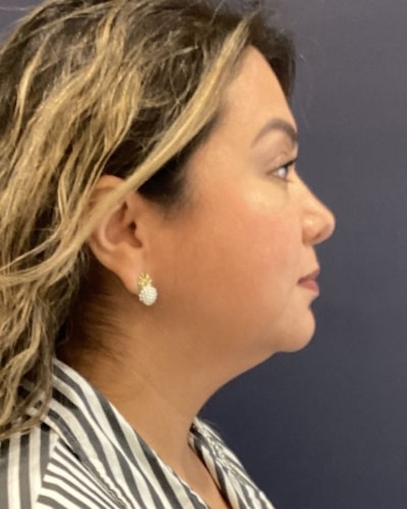 Facelift and Neck Lift Before & After Gallery - Patient 142028 - Image 3