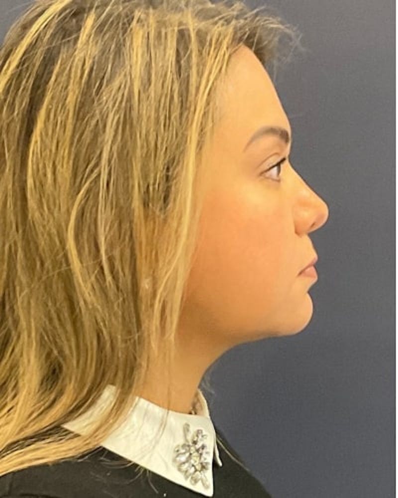 Facelift and Neck Lift Before & After Gallery - Patient 142028 - Image 4