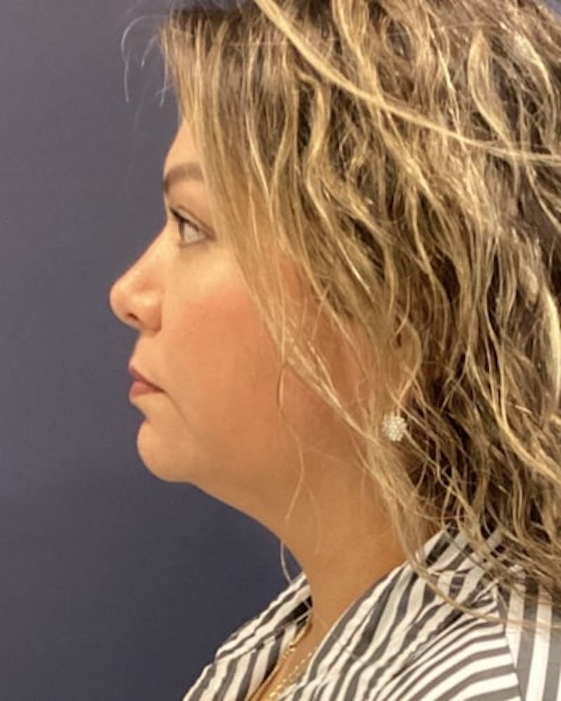 Facelift and Neck Lift Before & After Gallery - Patient 142028 - Image 5