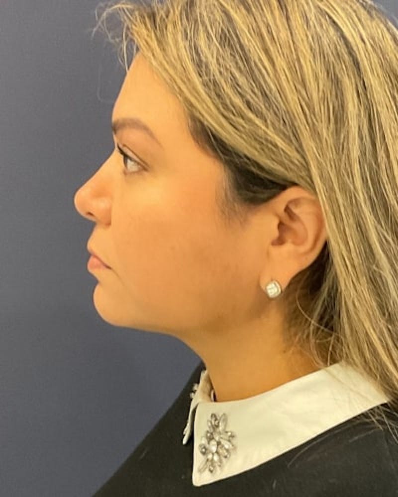 Facelift and Neck Lift Before & After Gallery - Patient 142028 - Image 6