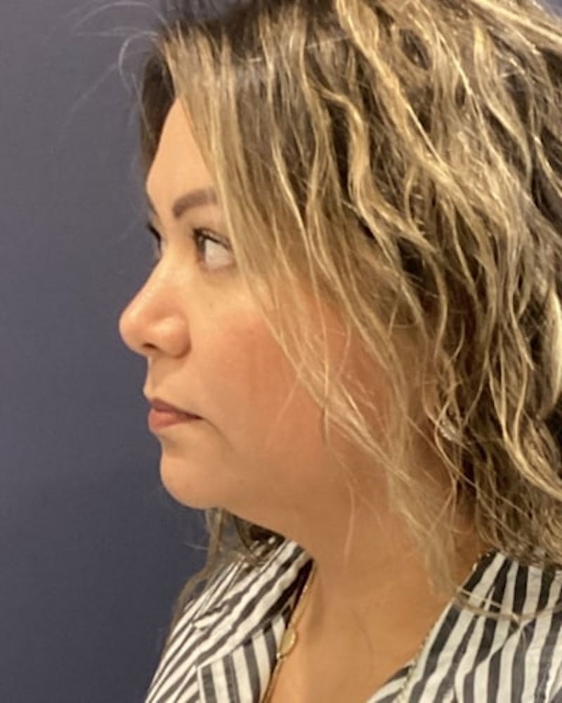 Facelift and Neck Lift Before & After Gallery - Patient 142028 - Image 7