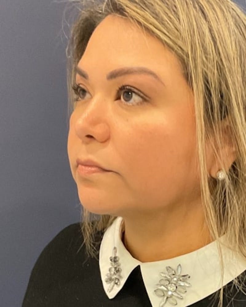 Facelift and Neck Lift Before & After Gallery - Patient 142028 - Image 8