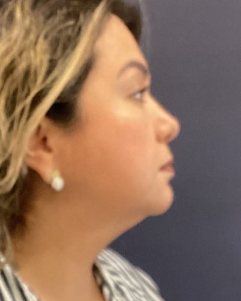 Facelift and Neck Lift Before & After Gallery - Patient 142028 - Image 9