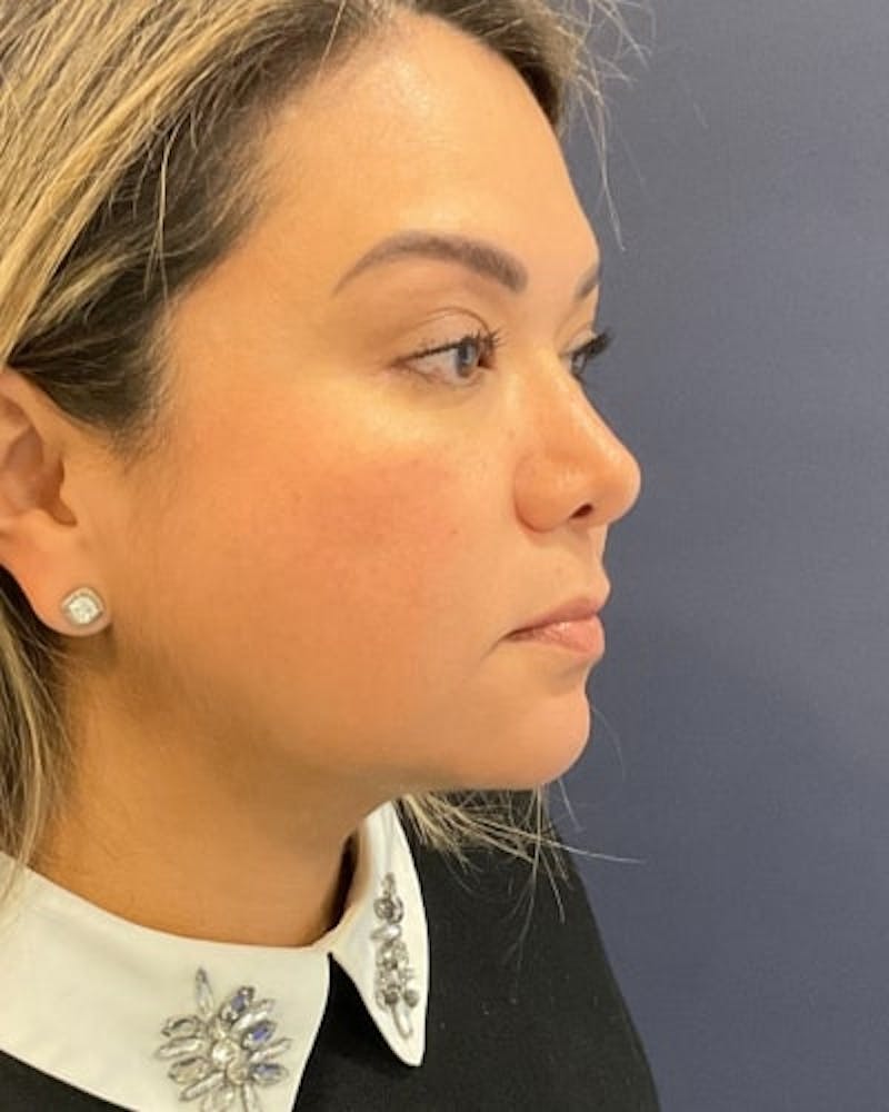 Facelift and Neck Lift Before & After Gallery - Patient 142028 - Image 10