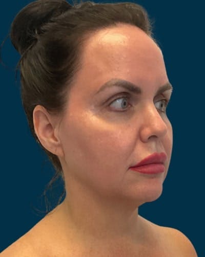 Facelift and Neck Lift Before & After Gallery - Patient 339008 - Image 1