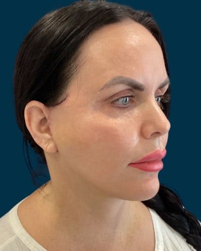 Facelift and Neck Lift Before & After Gallery - Patient 339008 - Image 2
