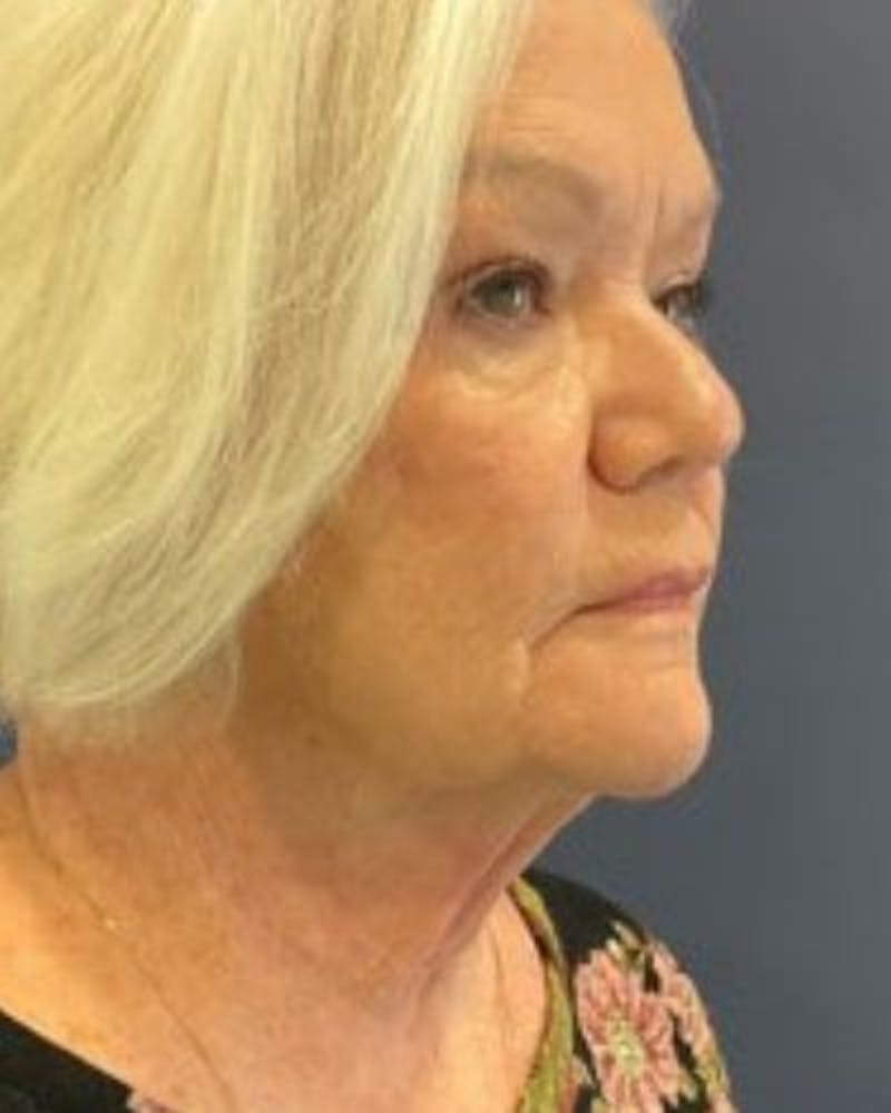Facelift and Neck Lift Before & After Gallery - Patient 380023 - Image 1
