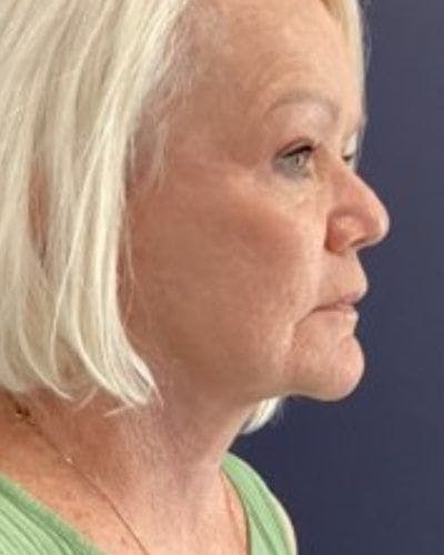 Facelift and Neck Lift Before & After Gallery - Patient 380023 - Image 2