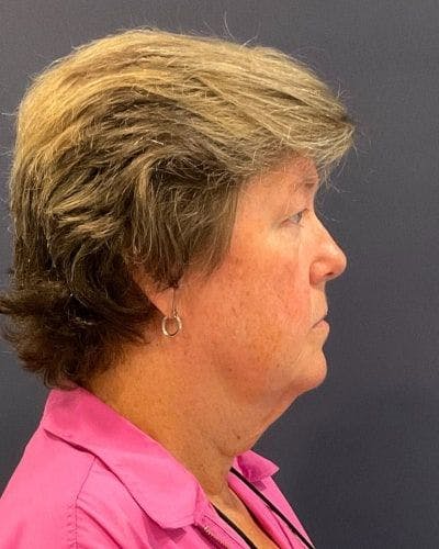 Facelift and Neck Lift Before & After Gallery - Patient 132558 - Image 1