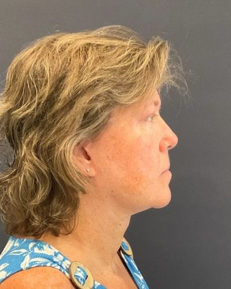 Facelift and Neck Lift Before & After Gallery - Patient 132558 - Image 2