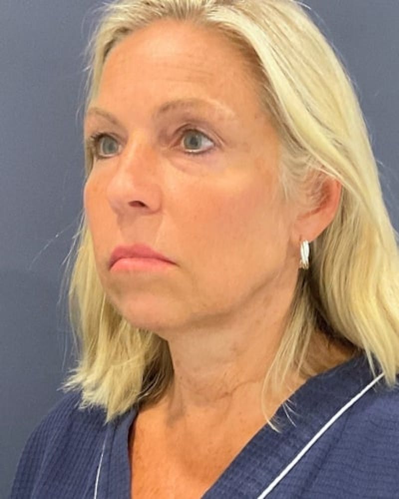 Facelift and Neck Lift Before & After Gallery - Patient 735310 - Image 1