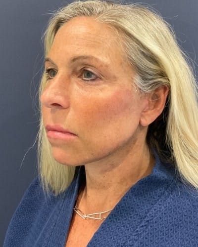 Facelift and Neck Lift Before & After Gallery - Patient 735310 - Image 2