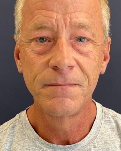 Facelift and Neck Lift Before & After Gallery - Patient 367212 - Image 2