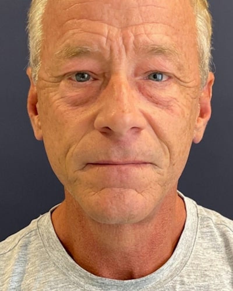 Facelift and Neck Lift Before & After Gallery - Patient 367212 - Image 2