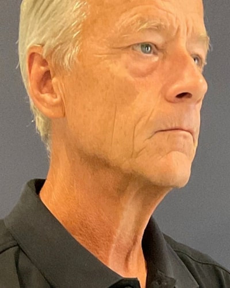 Facelift and Neck Lift Before & After Gallery - Patient 367212 - Image 3
