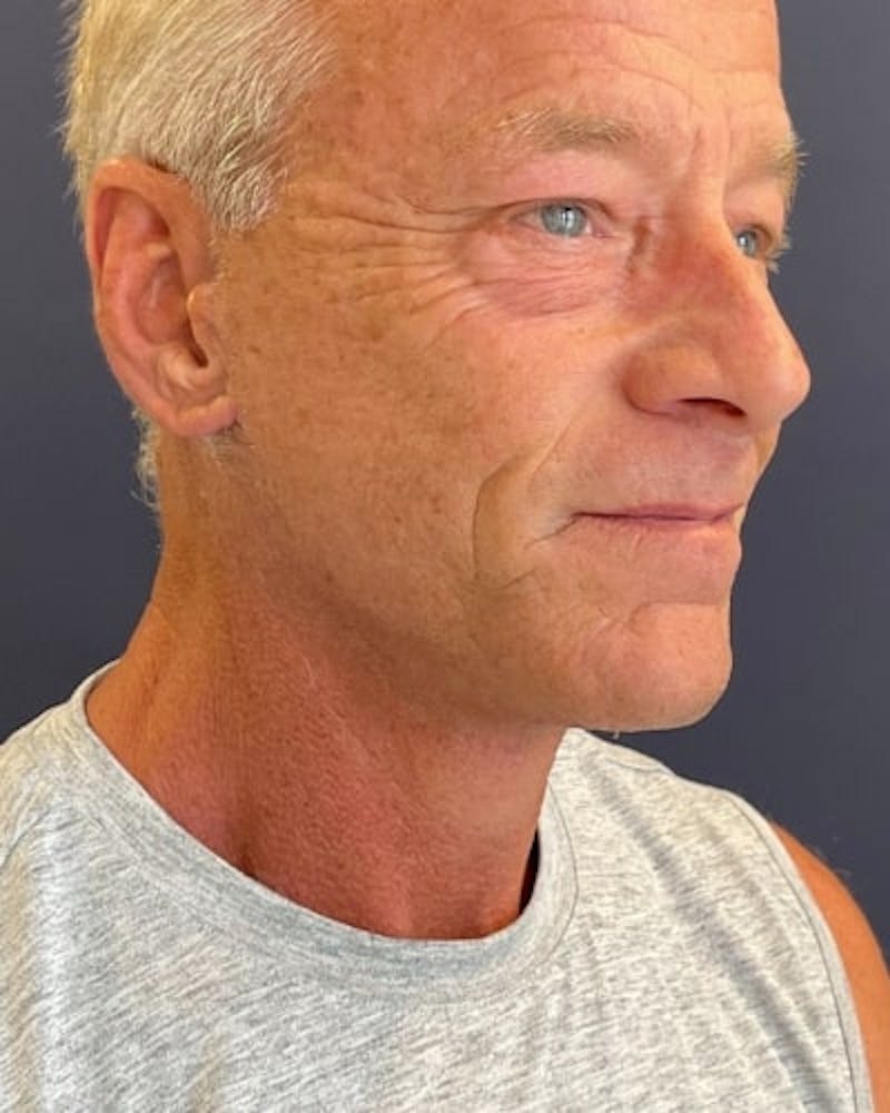 Facelift and Neck Lift Before & After Gallery - Patient 367212 - Image 4