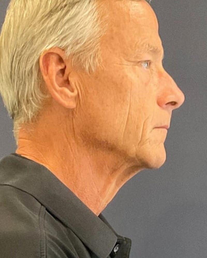 Facelift and Neck Lift Before & After Gallery - Patient 367212 - Image 5