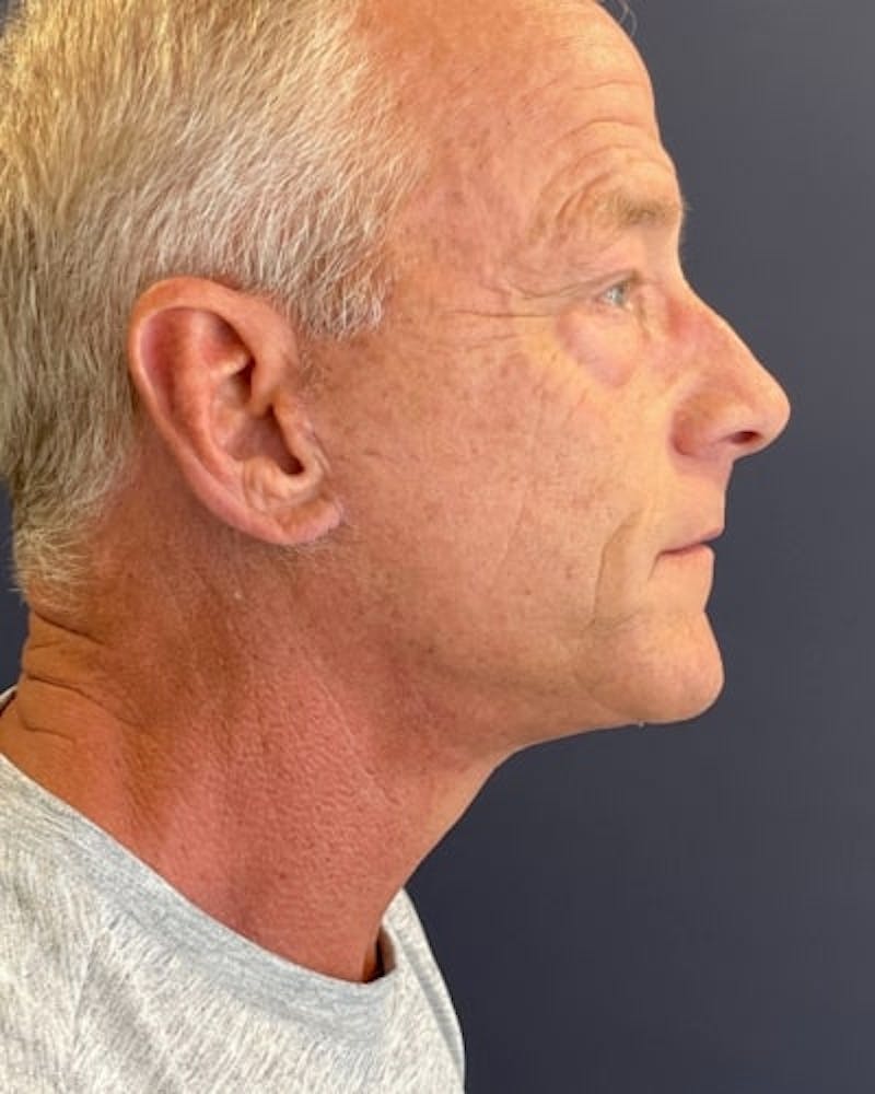 Facelift and Neck Lift Before & After Gallery - Patient 367212 - Image 6