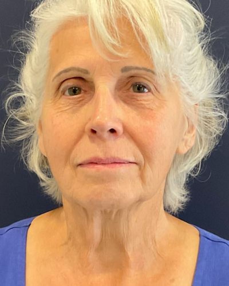 Facelift and Neck Lift Before & After Gallery - Patient 427969 - Image 1
