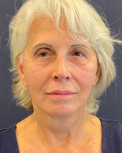 Facelift and Neck Lift Before & After Gallery - Patient 427969 - Image 2