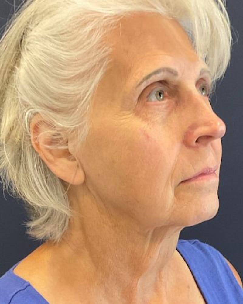 Facelift and Neck Lift Before & After Gallery - Patient 427969 - Image 3