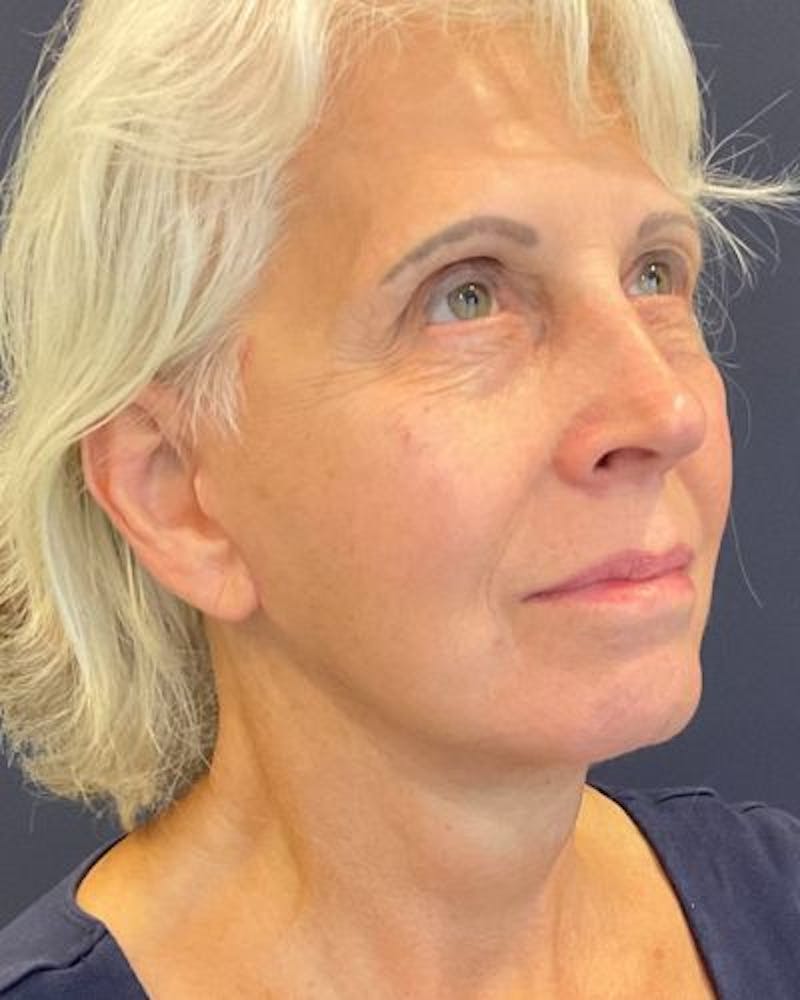 Facelift and Neck Lift Before & After Gallery - Patient 427969 - Image 4