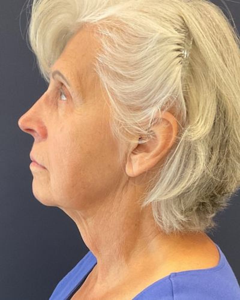 Facelift and Neck Lift Before & After Gallery - Patient 427969 - Image 5
