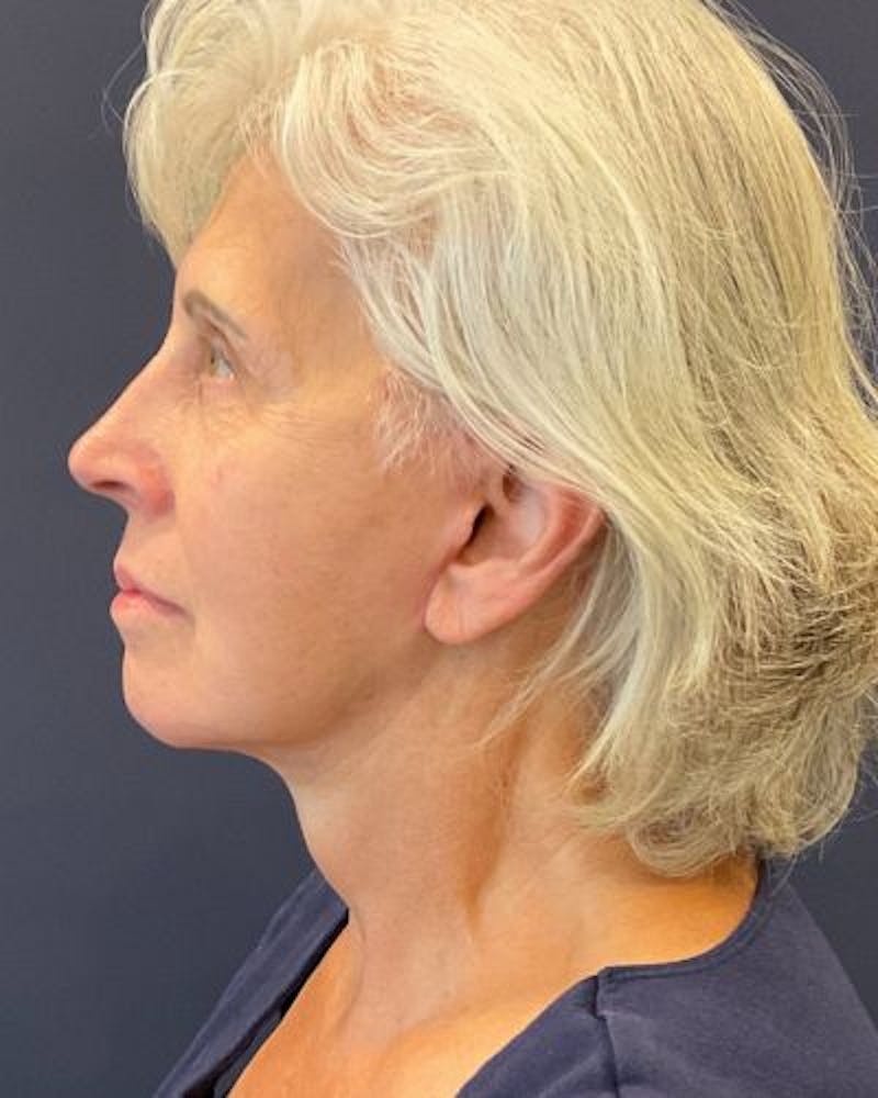 Facelift and Neck Lift Before & After Gallery - Patient 427969 - Image 6