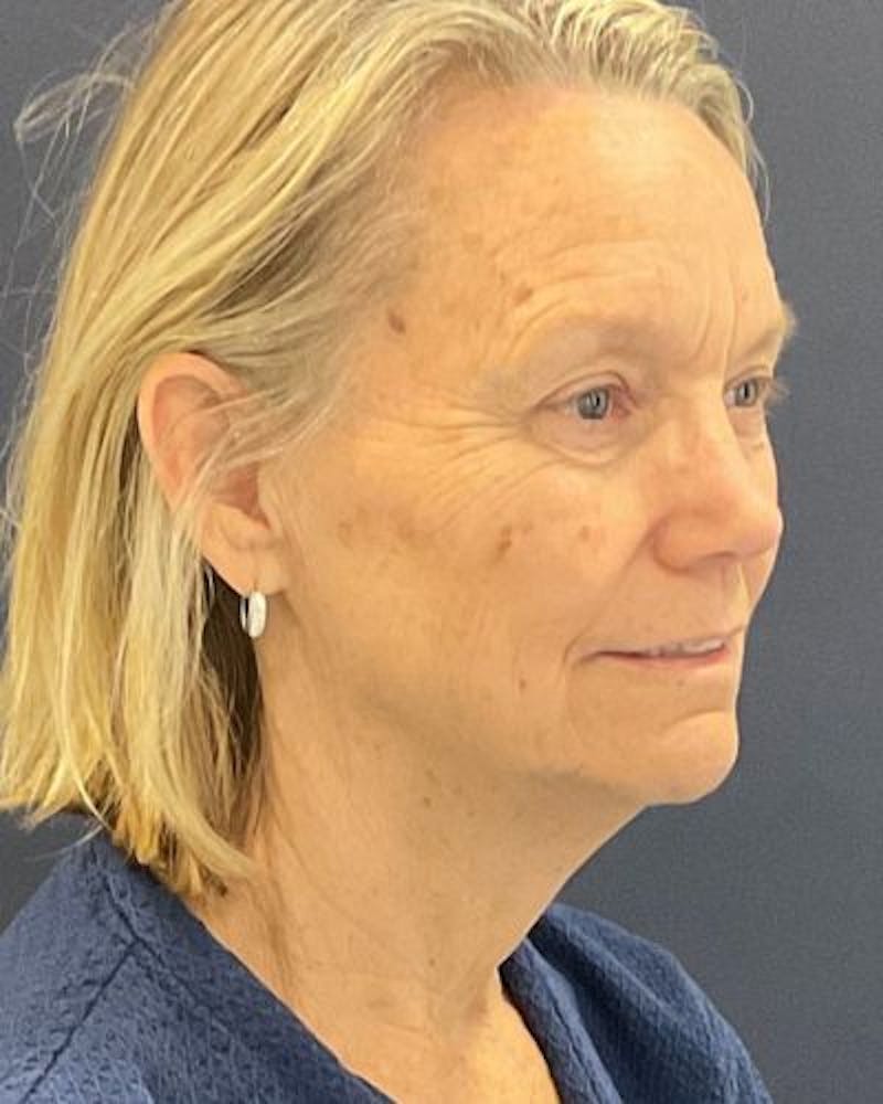 Facelift and Neck Lift Before & After Gallery - Patient 676227 - Image 1