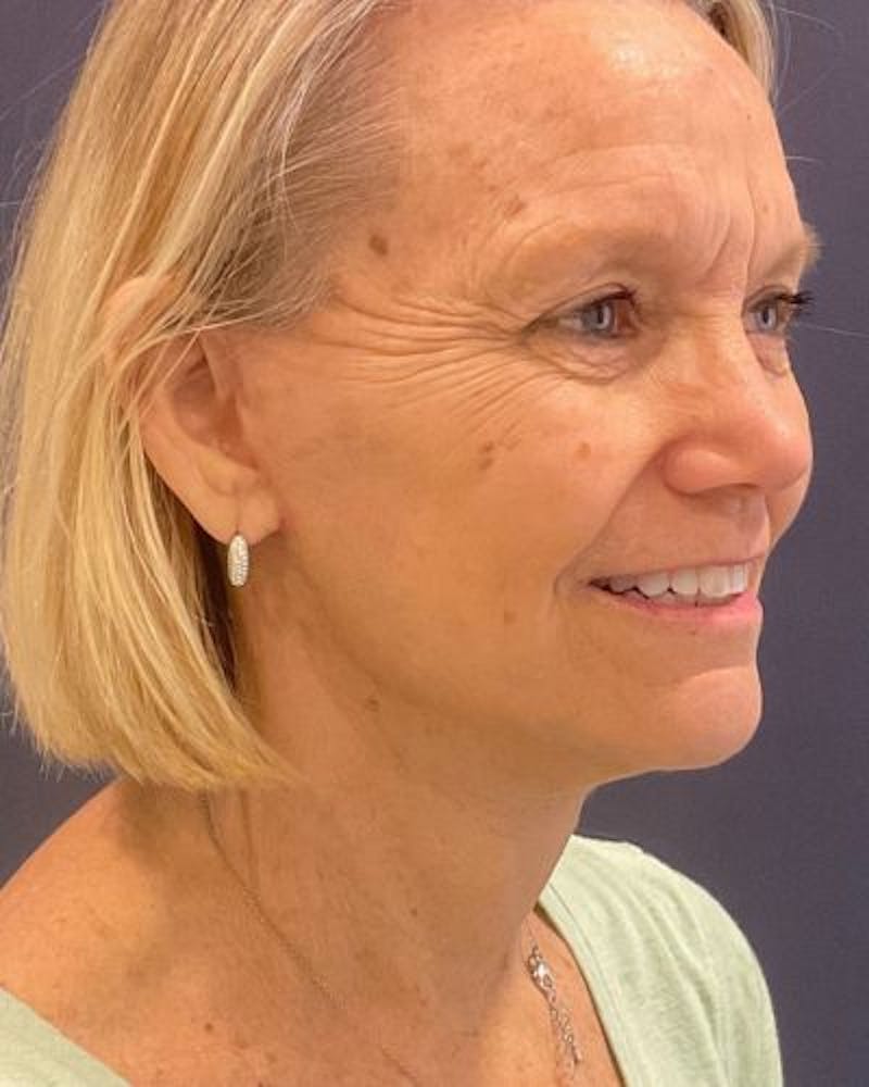 Facelift and Neck Lift Before & After Gallery - Patient 676227 - Image 2