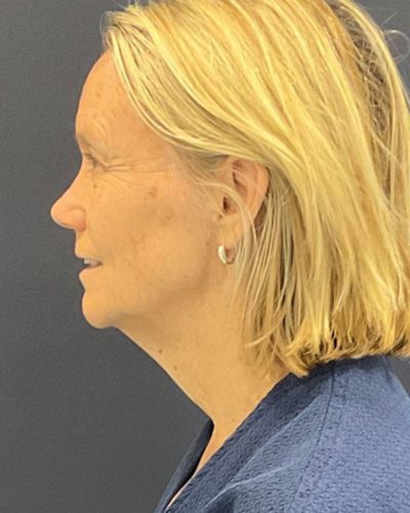Facelift and Neck Lift Before & After Gallery - Patient 676227 - Image 3