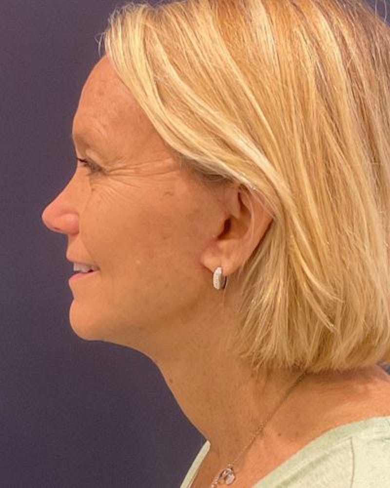 Facelift and Neck Lift Before & After Gallery - Patient 676227 - Image 4