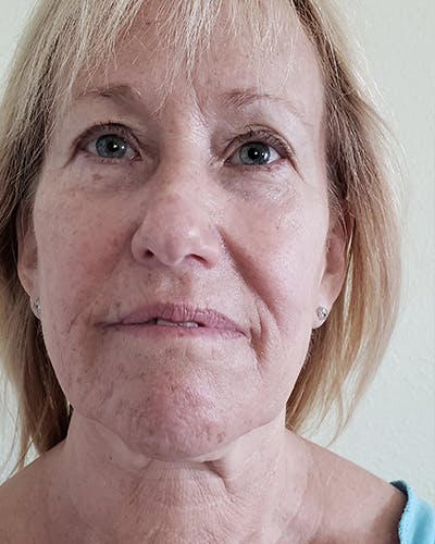 Facelift and Neck Lift Before & After Gallery - Patient 550518 - Image 1