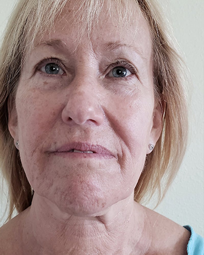 Facelift and Neck Lift Before & After Gallery - Patient 550518 - Image 1