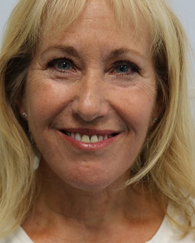 Facelift and Neck Lift Before & After Gallery - Patient 550518 - Image 2