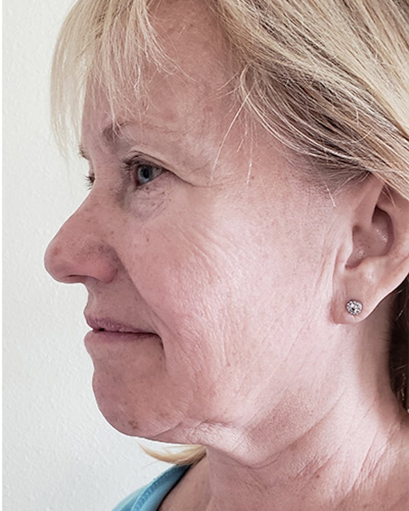 Facelift and Neck Lift Before & After Gallery - Patient 550518 - Image 3